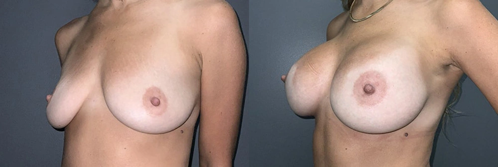 Real Patient Results in Newport Beach, CA. Preformed by Semira Bayait, MD, FACS.