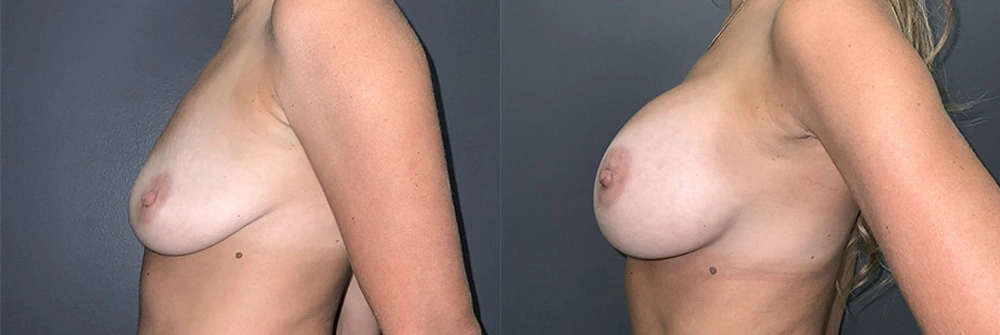 Real Patient Results in Newport Beach, CA. Preformed by Semira Bayait, MD, FACS.