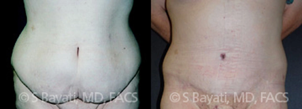 Real Patient Results in Newport Beach, CA. Preformed by Semira Bayait, MD, FACS.