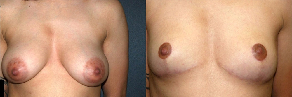 Real Patient Results in Newport Beach, CA. Preformed by Semira Bayait, MD, FACS.