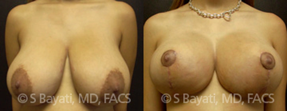 Real Patient Results in Newport Beach, CA. Preformed by Semira Bayait, MD, FACS.