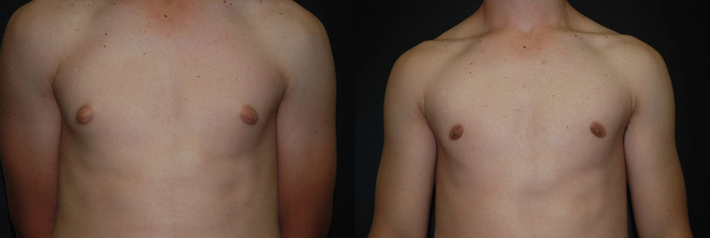Real Patient Results in Newport Beach, CA. Preformed by Semira Bayait, MD, FACS.