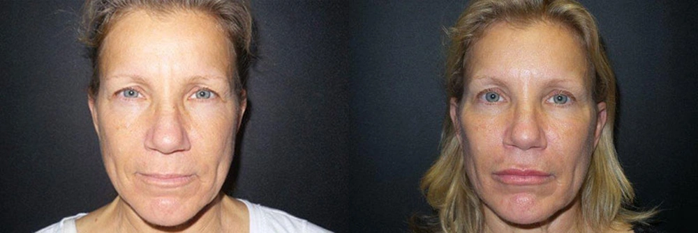 Real Patient Results in Newport Beach, CA. Preformed by Semira Bayait, MD, FACS.
