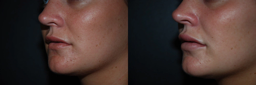 Real Patient Results in Newport Beach, CA. Preformed by Semira Bayait, MD, FACS.