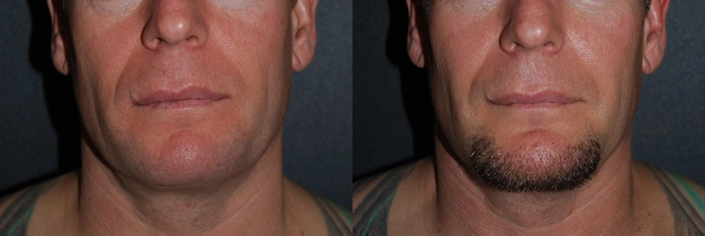 Real Patient Results in Newport Beach, CA. Preformed by Semira Bayait, MD, FACS.