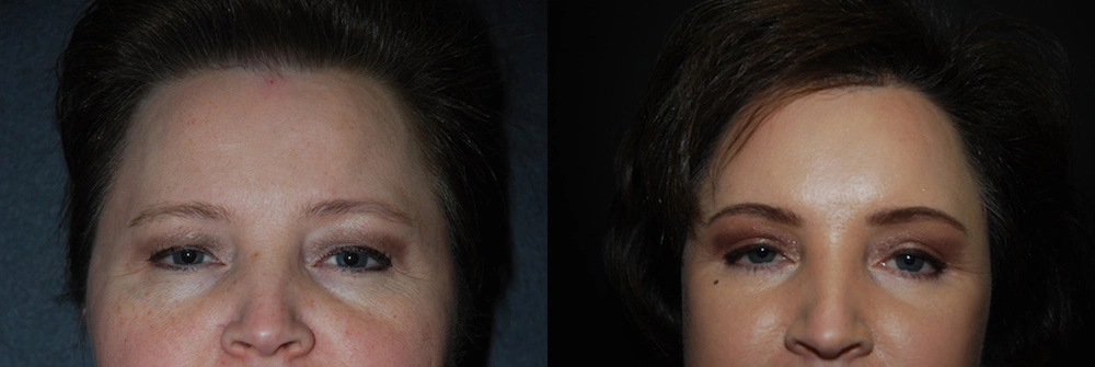 Real Patient Results in Newport Beach, CA. Preformed by Semira Bayait, MD, FACS.