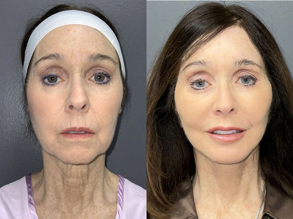 Real Patient Results in Newport Beach, CA. Preformed by Semira Bayait, MD, FACS.