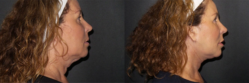 Real Patient Results in Newport Beach, CA. Preformed by Semira Bayait, MD, FACS.