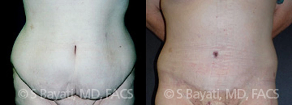 Real Patient Results in Newport Beach, CA. Preformed by Semira Bayait, MD, FACS.