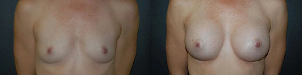 Real Patient Results in Newport Beach, CA. Preformed by Semira Bayait, MD, FACS.