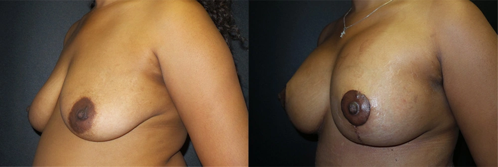 Real Patient Results in Newport Beach, CA. Preformed by Semira Bayait, MD, FACS.