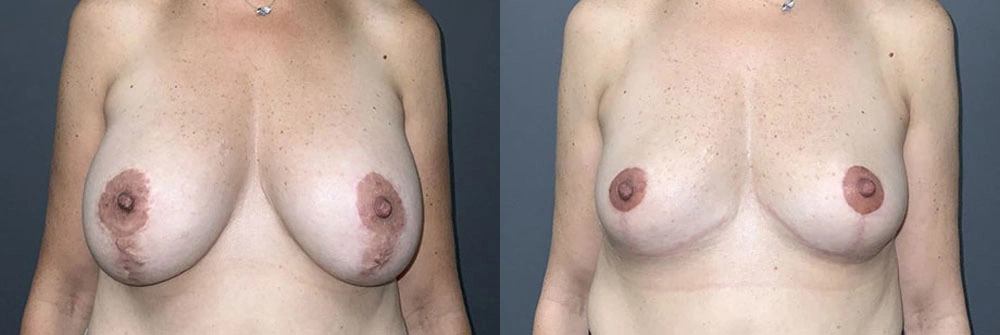 Real Patient Results in Newport Beach, CA. Preformed by Semira Bayait, MD, FACS.