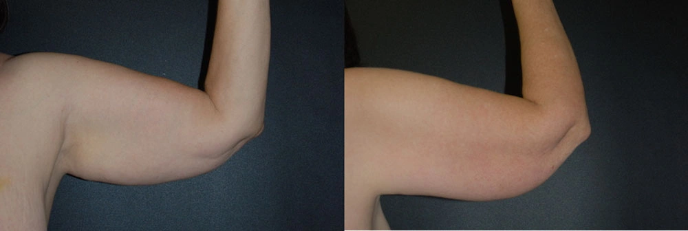 Real Patient Results in Newport Beach, CA. Preformed by Semira Bayait, MD, FACS.
