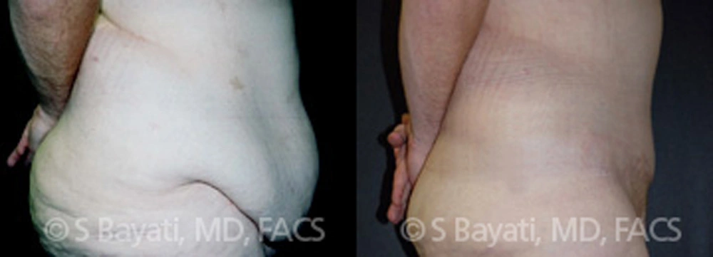 Real Patient Results in Newport Beach, CA. Preformed by Semira Bayait, MD, FACS.