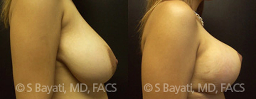 Real Patient Results in Newport Beach, CA. Preformed by Semira Bayait, MD, FACS.