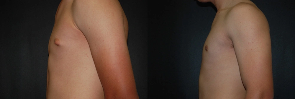 Real Patient Results in Newport Beach, CA. Preformed by Semira Bayait, MD, FACS.