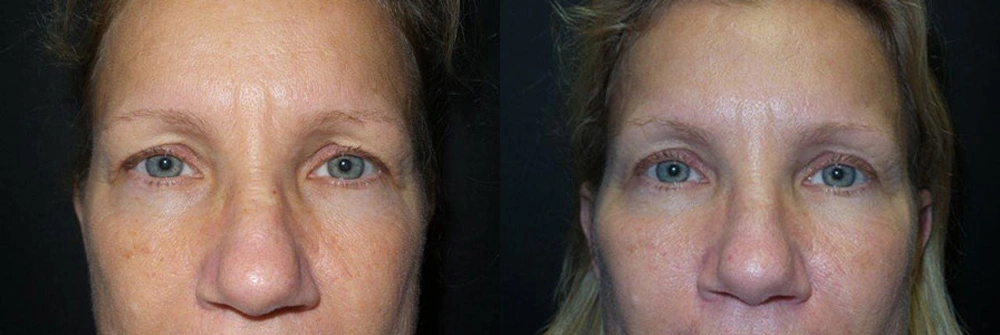 Real Patient Results in Newport Beach, CA. Preformed by Semira Bayait, MD, FACS.