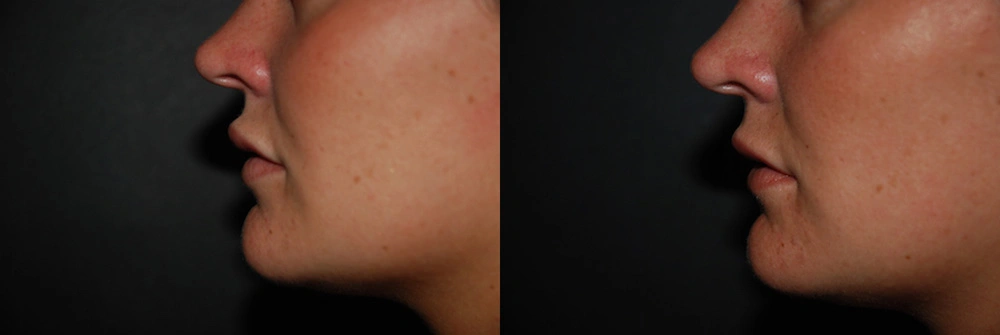 Real Patient Results in Newport Beach, CA. Preformed by Semira Bayait, MD, FACS.