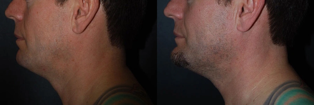 Real Patient Results in Newport Beach, CA. Preformed by Semira Bayait, MD, FACS.