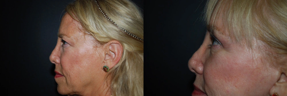 Real Patient Results in Newport Beach, CA. Preformed by Semira Bayait, MD, FACS.
