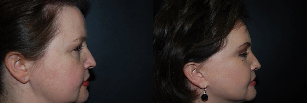 Real Patient Results in Newport Beach, CA. Preformed by Semira Bayait, MD, FACS.