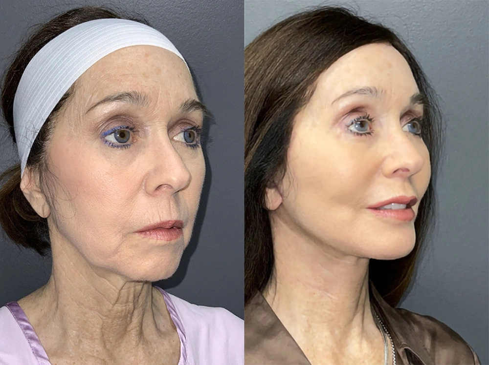 Real Patient Results in Newport Beach, CA. Preformed by Semira Bayait, MD, FACS.
