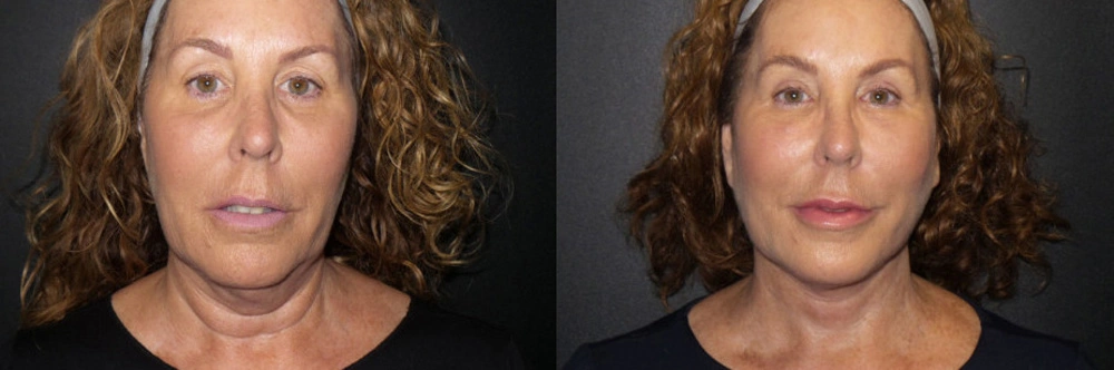 Real Patient Results in Newport Beach, CA. Preformed by Semira Bayait, MD, FACS.