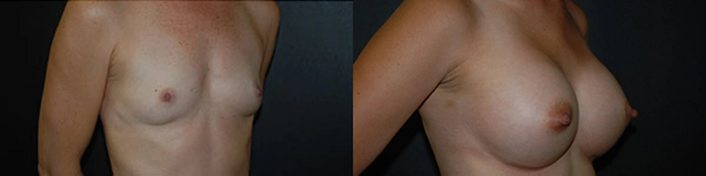 Real Patient Results in Newport Beach, CA. Preformed by Semira Bayait, MD, FACS.