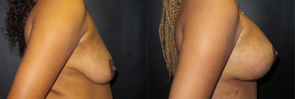 Real Patient Results in Newport Beach, CA. Preformed by Semira Bayait, MD, FACS.