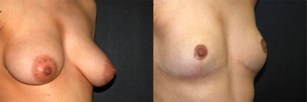 Real Patient Results in Newport Beach, CA. Preformed by Semira Bayait, MD, FACS.