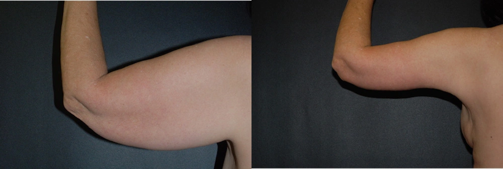 Real Patient Results in Newport Beach, CA. Preformed by Semira Bayait, MD, FACS.