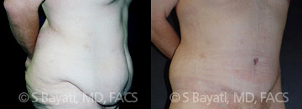 Real Patient Results in Newport Beach, CA. Preformed by Semira Bayait, MD, FACS.