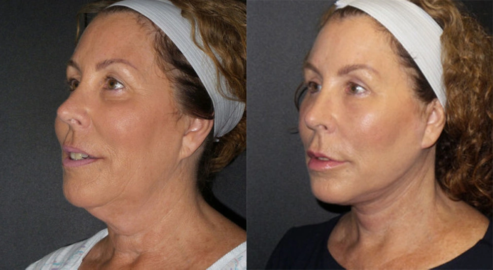 Real Patient Results in Newport Beach, CA. Preformed by Semira Bayait, MD, FACS.