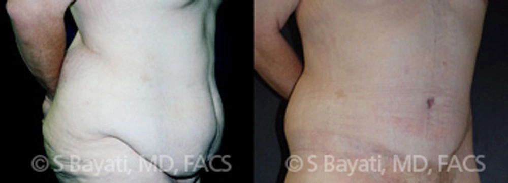 Real Patient Results in Newport Beach, CA. Preformed by Semira Bayait, MD, FACS.