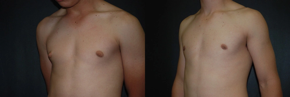 Real Patient Results in Newport Beach, CA. Preformed by Semira Bayait, MD, FACS.