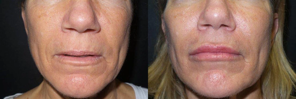 Real Patient Results in Newport Beach, CA. Preformed by Semira Bayait, MD, FACS.