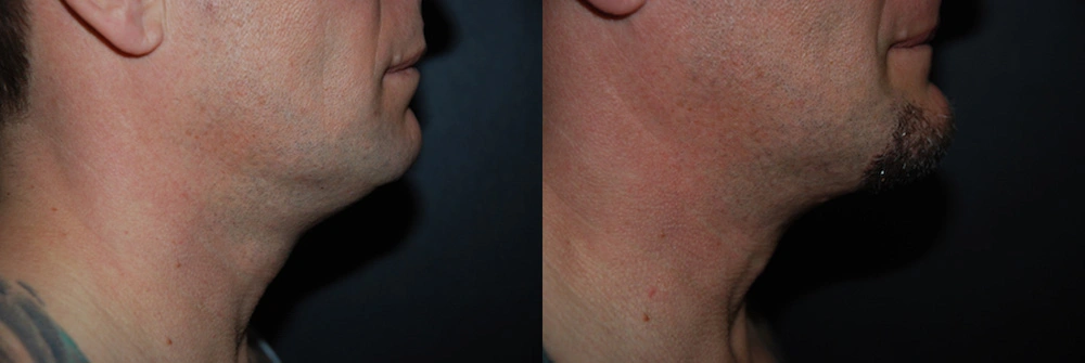 Real Patient Results in Newport Beach, CA. Preformed by Semira Bayait, MD, FACS.