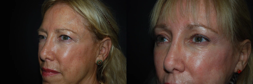 Real Patient Results in Newport Beach, CA. Preformed by Semira Bayait, MD, FACS.
