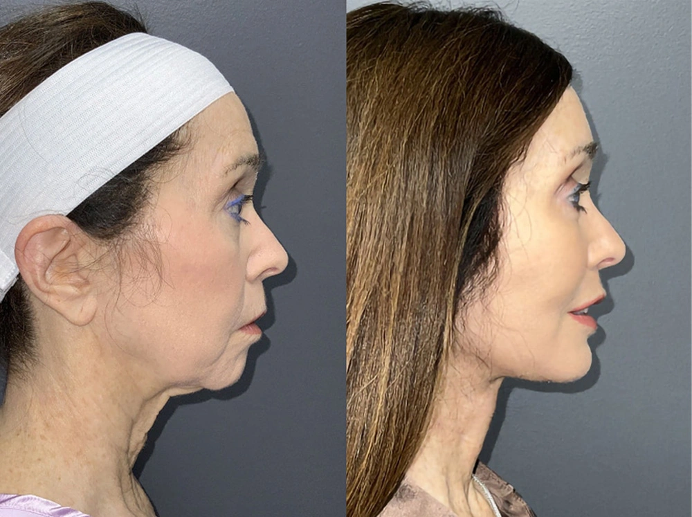Real Patient Results in Newport Beach, CA. Preformed by Semira Bayait, MD, FACS.