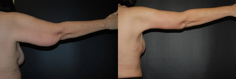Real Patient Results in Newport Beach, CA. Preformed by Semira Bayait, MD, FACS.
