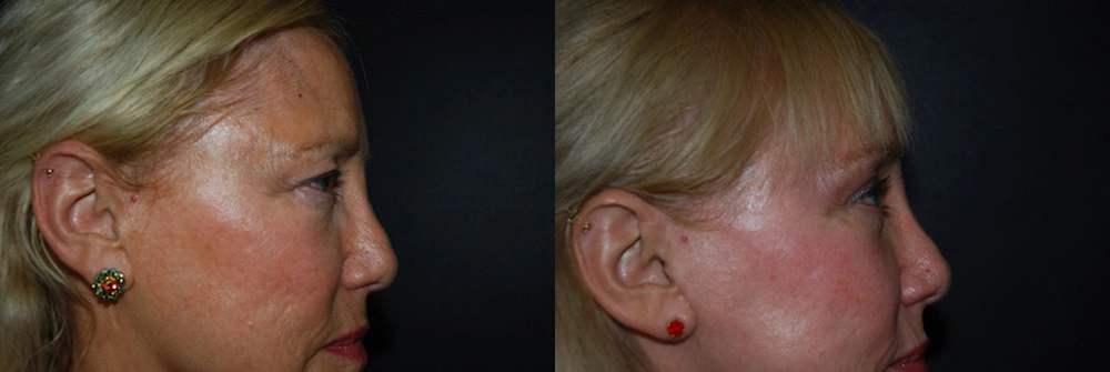 Real Patient Results in Newport Beach, CA. Preformed by Semira Bayait, MD, FACS.