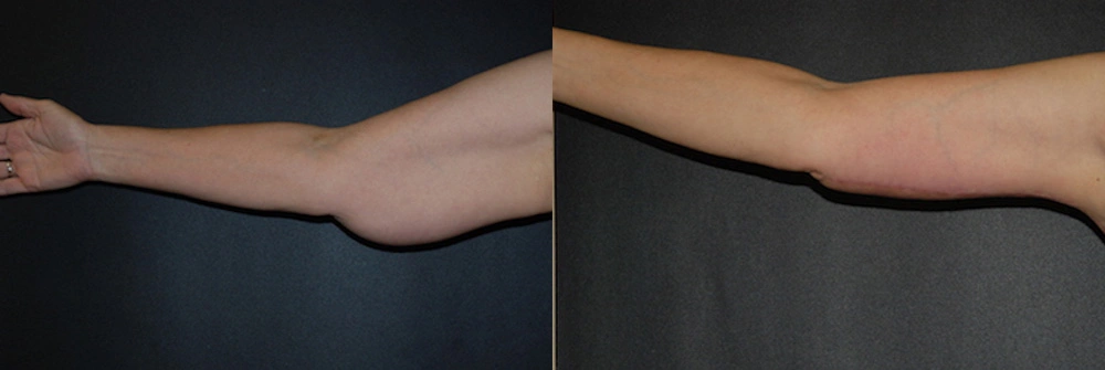 Real Patient Results in Newport Beach, CA. Preformed by Semira Bayait, MD, FACS.