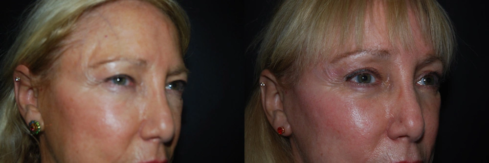 Real Patient Results in Newport Beach, CA. Preformed by Semira Bayait, MD, FACS.