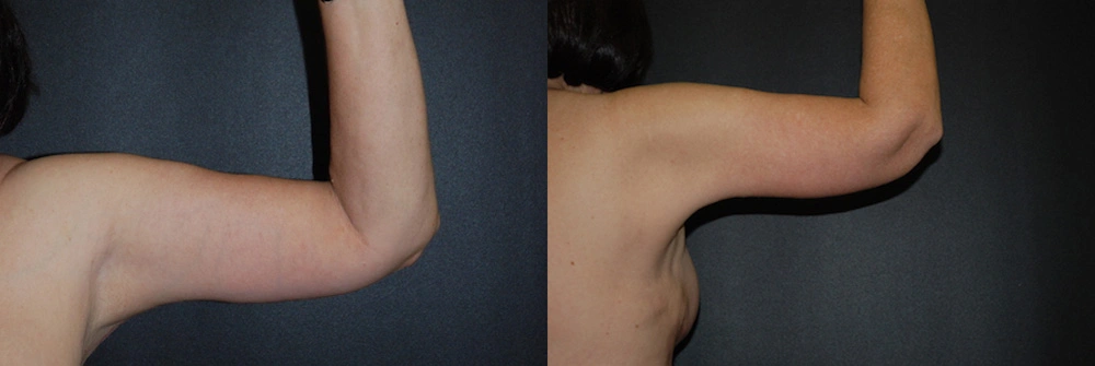 Real Patient Results in Newport Beach, CA. Preformed by Semira Bayait, MD, FACS.