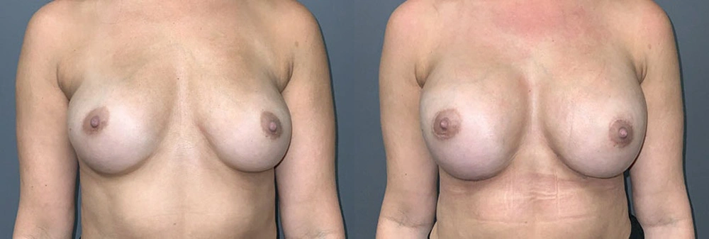 Real Patient Results in Newport Beach, CA. Preformed by Semira Bayait, MD, FACS.