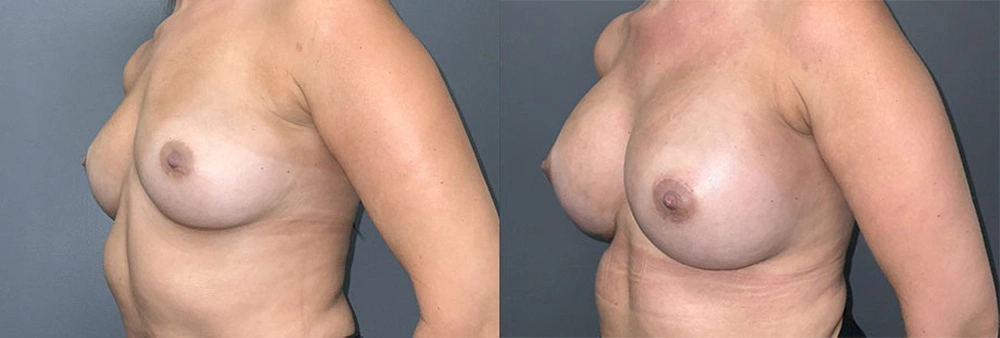 Real Patient Results in Newport Beach, CA. Preformed by Semira Bayait, MD, FACS.