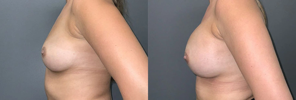 Real Patient Results in Newport Beach, CA. Preformed by Semira Bayait, MD, FACS.