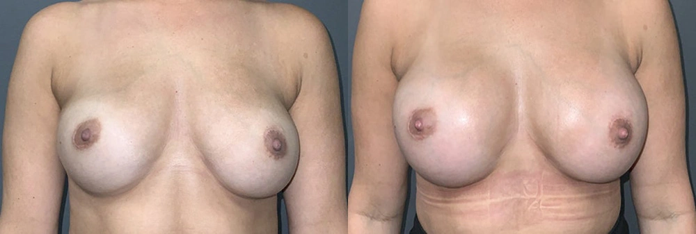 Real Patient Results in Newport Beach, CA. Preformed by Semira Bayait, MD, FACS.