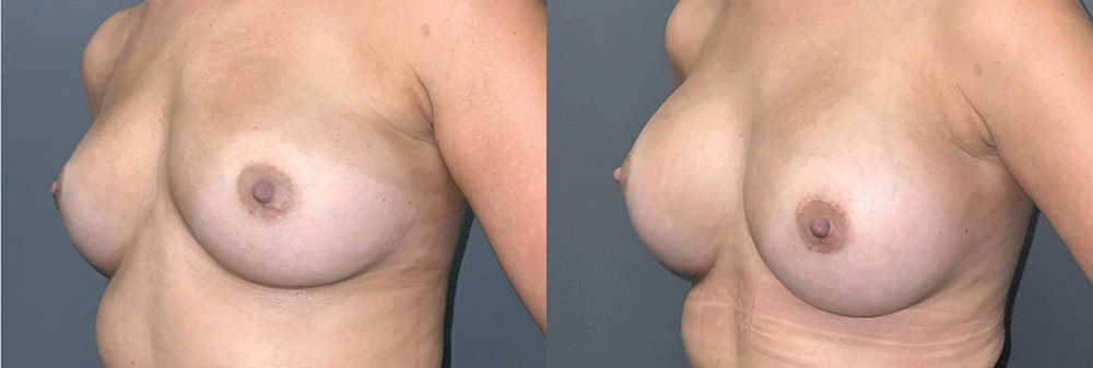 Real Patient Results in Newport Beach, CA. Preformed by Semira Bayait, MD, FACS.
