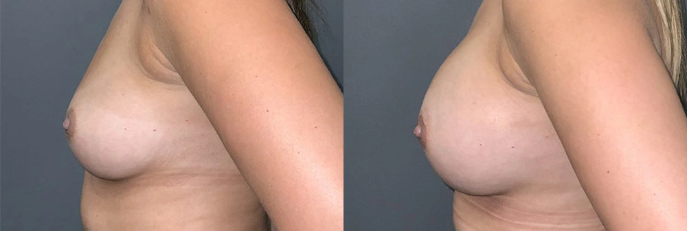 Real Patient Results in Newport Beach, CA. Preformed by Semira Bayait, MD, FACS.